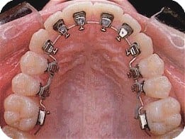 What in the World Are Lingual Braces?